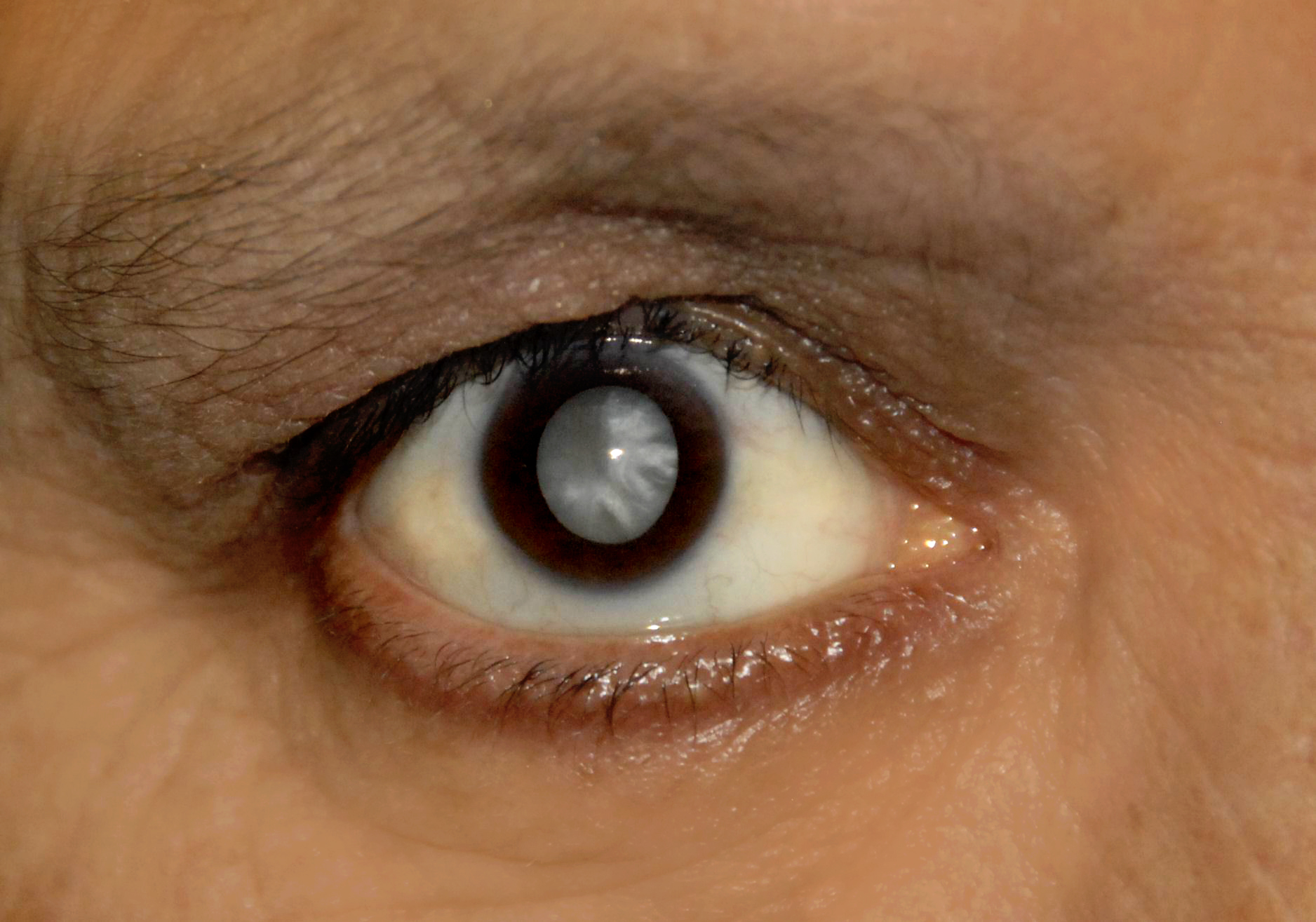 Novo laser facilita cirurgia de catarata - Ocular Max Care - Dr
